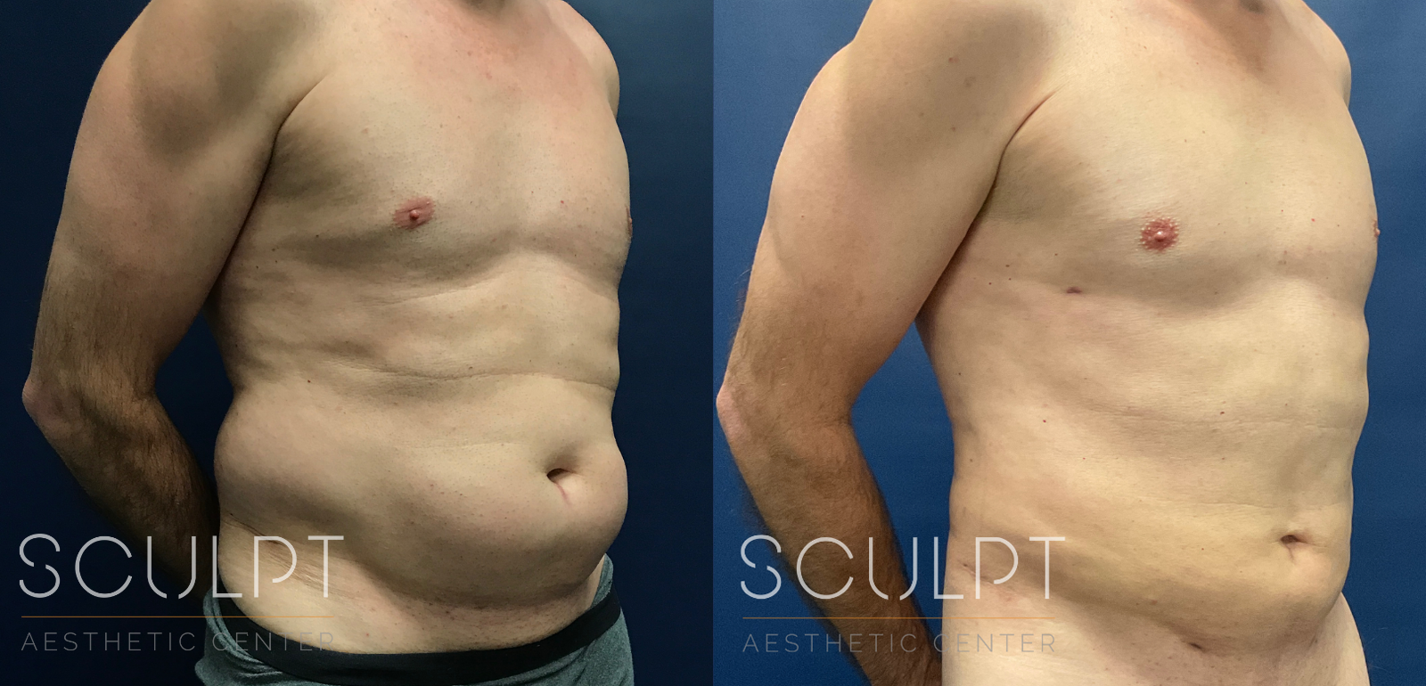 Liposuction to the Abdomen, Flanks, Back Before and After Photo by Sculpt Aesthetic Center in Frisco, TX