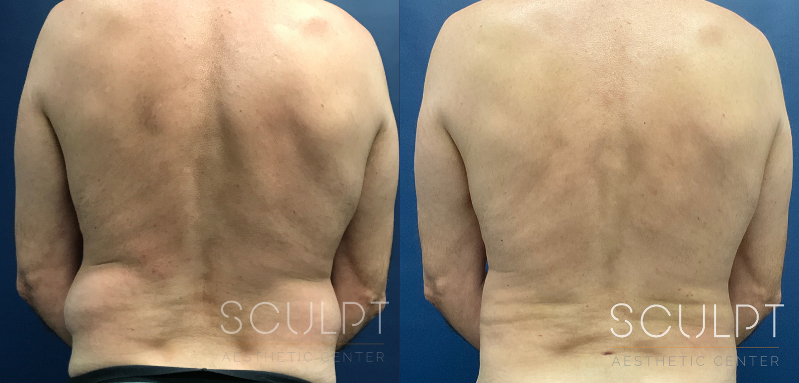 Liposuction to the Abdomen, Flanks, Back Before and After Photo by Sculpt Aesthetic Center in Frisco, TX