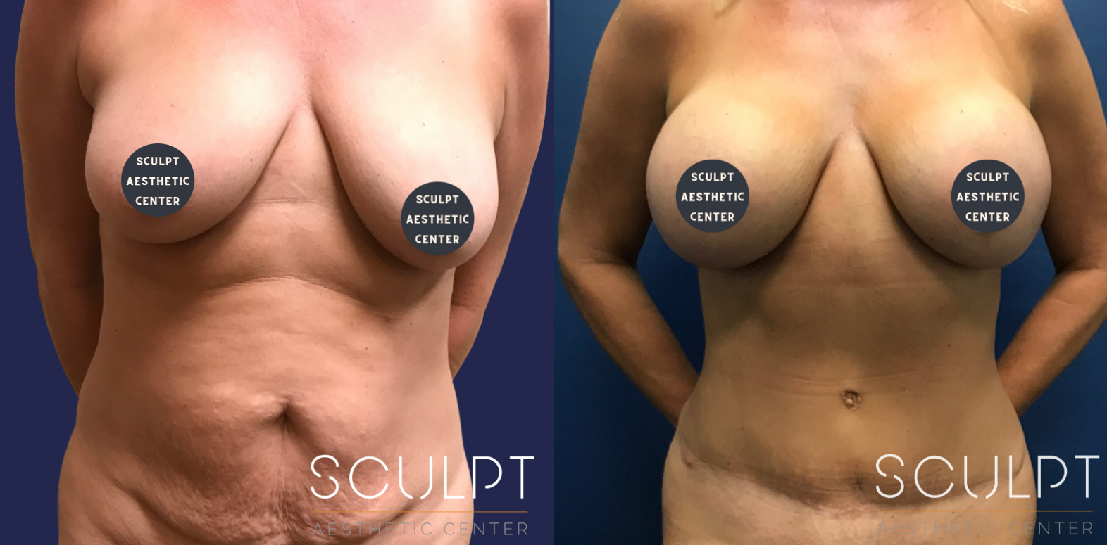 Breast Augmentation with Tummy Tuck Before and After Photo by Sculpt Aesthetic Center in Frisco, TX