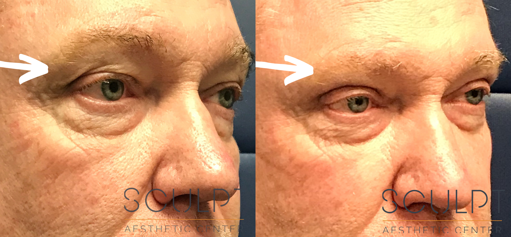 Upper Blepharoplasty Before and After Photo by Sculpt Aesthetic Center in Frisco, TX