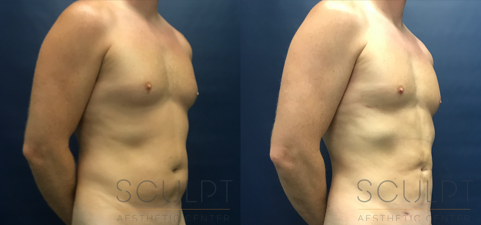 Liposuction to the Abdomen, Chest, Flanks Before and After Photo by Sculpt Aesthetic Center in Frisco, TX