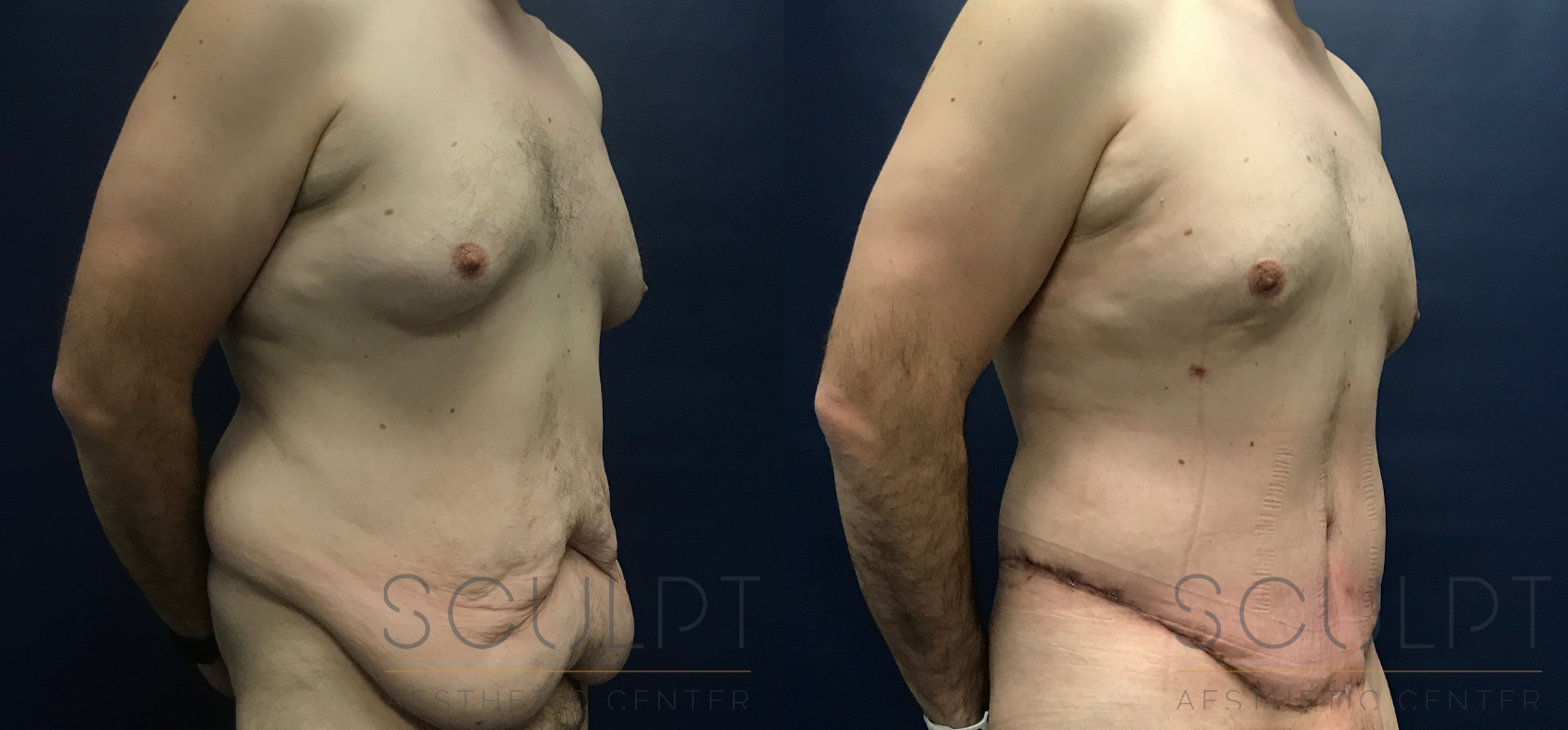 Male 360 Body Lift with Liposuction Before and After Photo by Sculpt Aesthetic Center in Frisco, TX