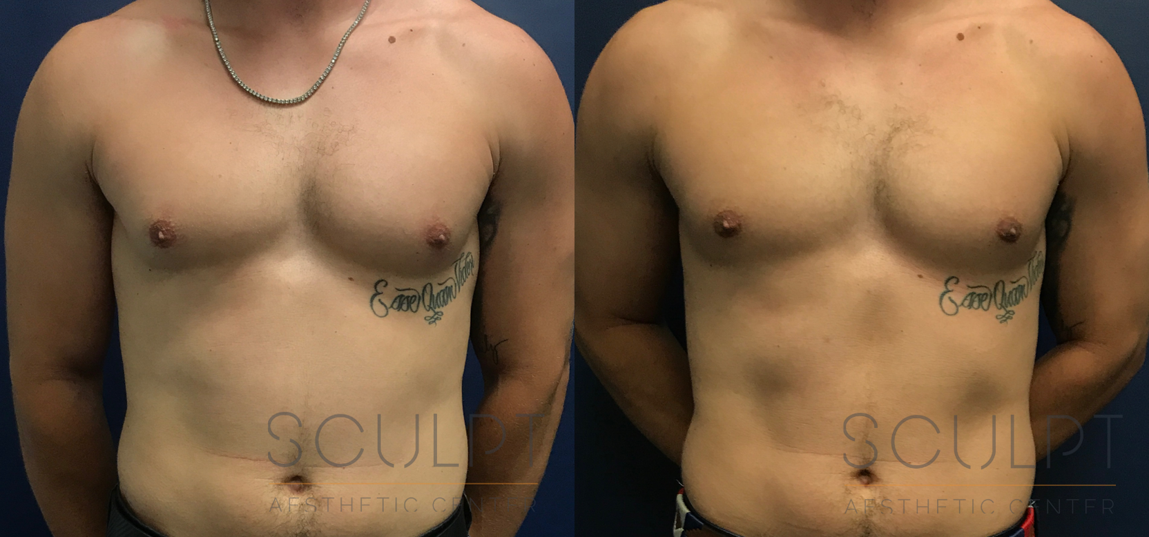 Gynecomastia Excision Before and After Photo by Sculpt Aesthetic Center in Frisco, TX
