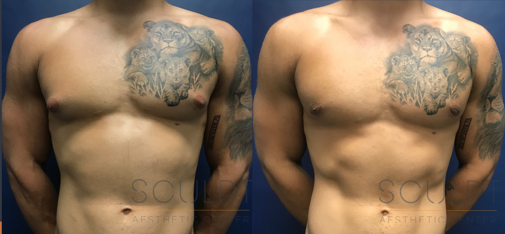 Gynecomastia Excision Before and After Photo by Sculpt Aesthetic Center in Frisco, TX