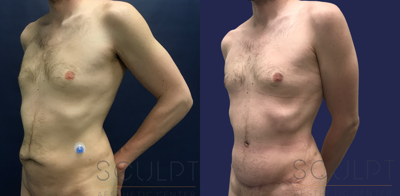 Male Tummy Tuck Before and After Photo by Sculpt Aesthetic Center in Frisco, TX