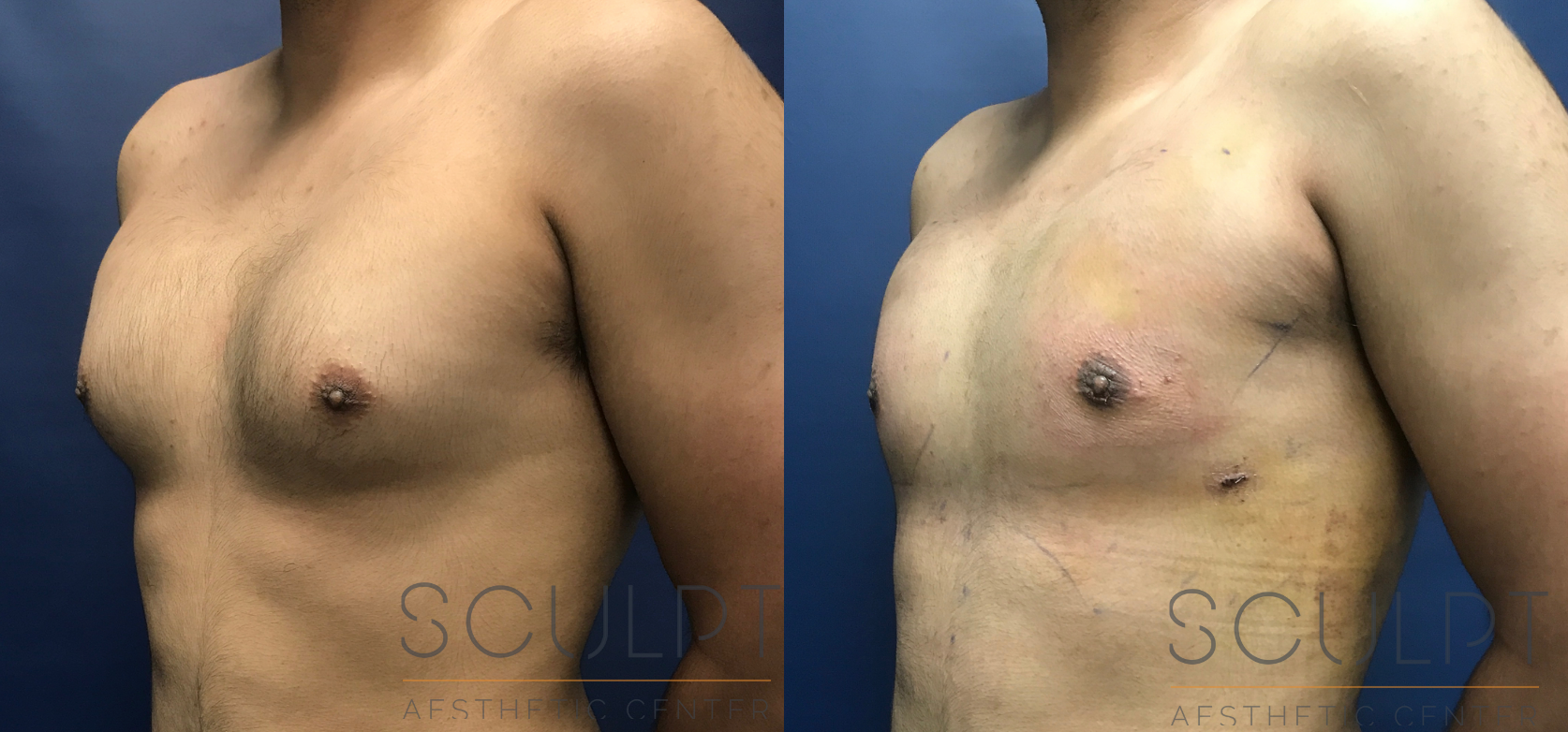 Gynecomastia Excision with Chest SCULPTing Before and After Photo by Sculpt Aesthetic Center in Frisco, TX