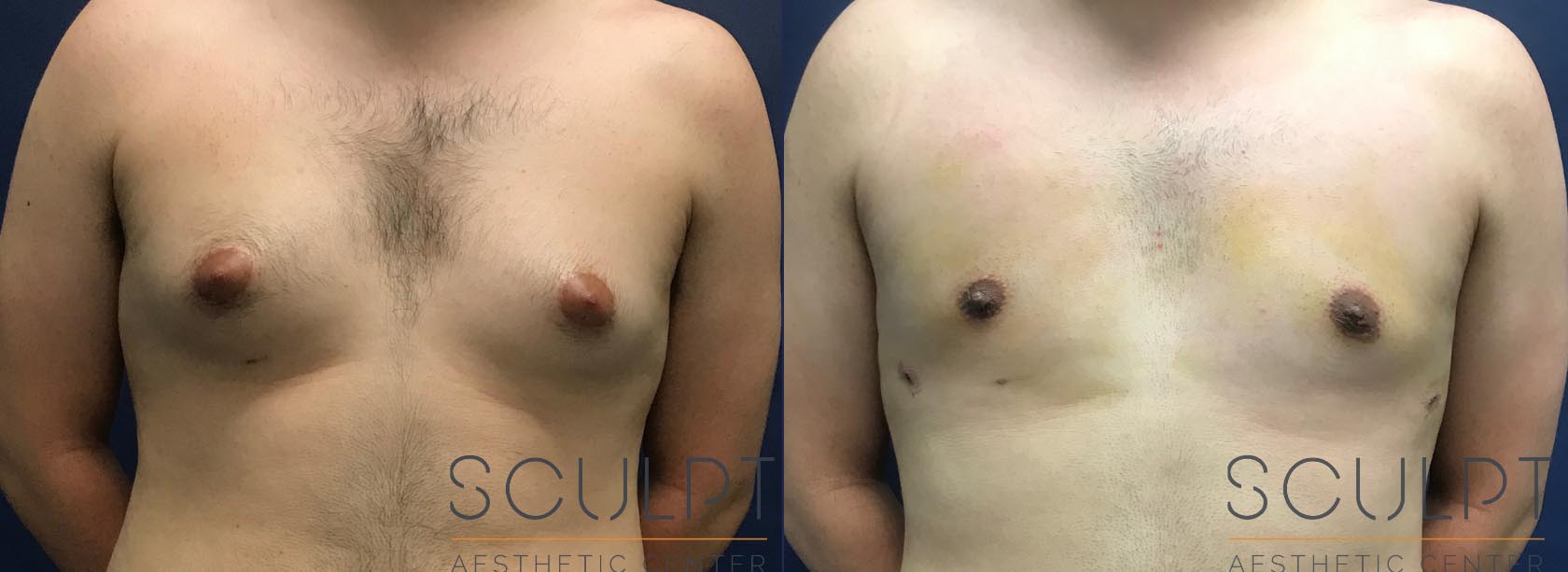 Gynecomastia Excision with Chest SCULPTing Before and After Photo by Sculpt Aesthetic Center in Frisco, TX