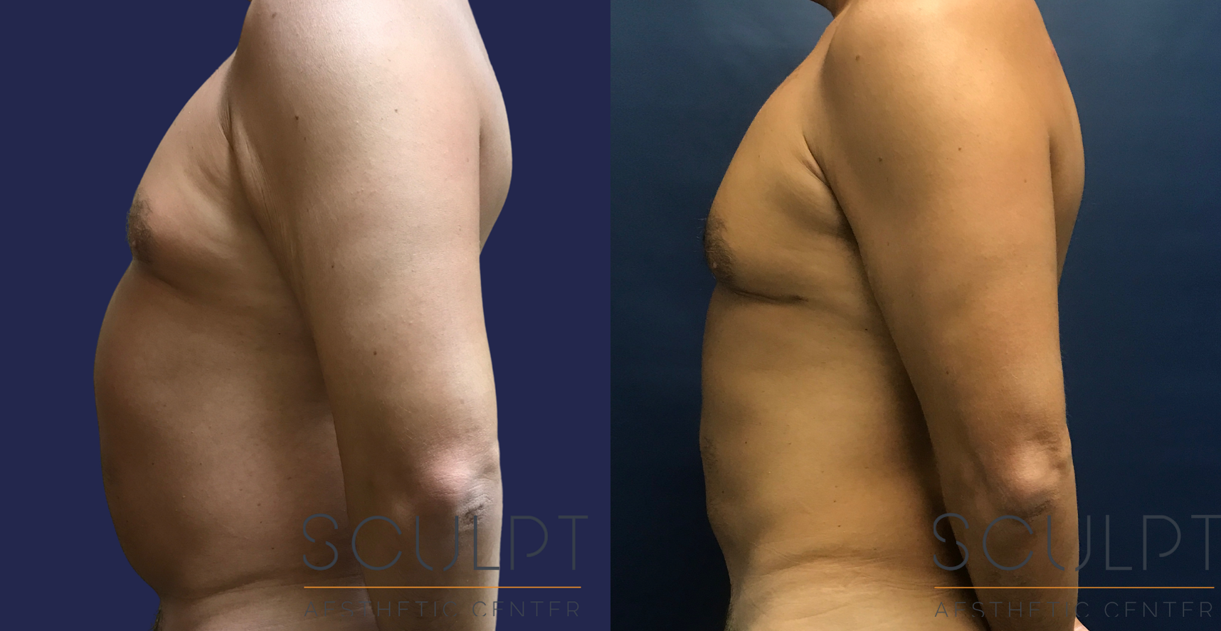 Liposuction to the Abdomen, Chest Before and After Photo by Sculpt Aesthetic Center in Frisco, TX