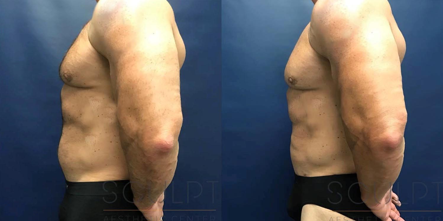 Liposuction to the Abdomen Before and After Photo by Sculpt Aesthetic Center in Frisco, TX