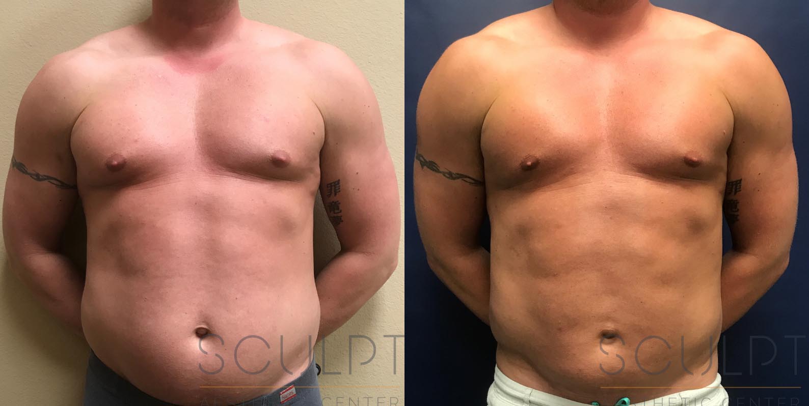 Liposuction to the Abdomen, Chest Before and After Photo by Sculpt Aesthetic Center in Frisco, TX