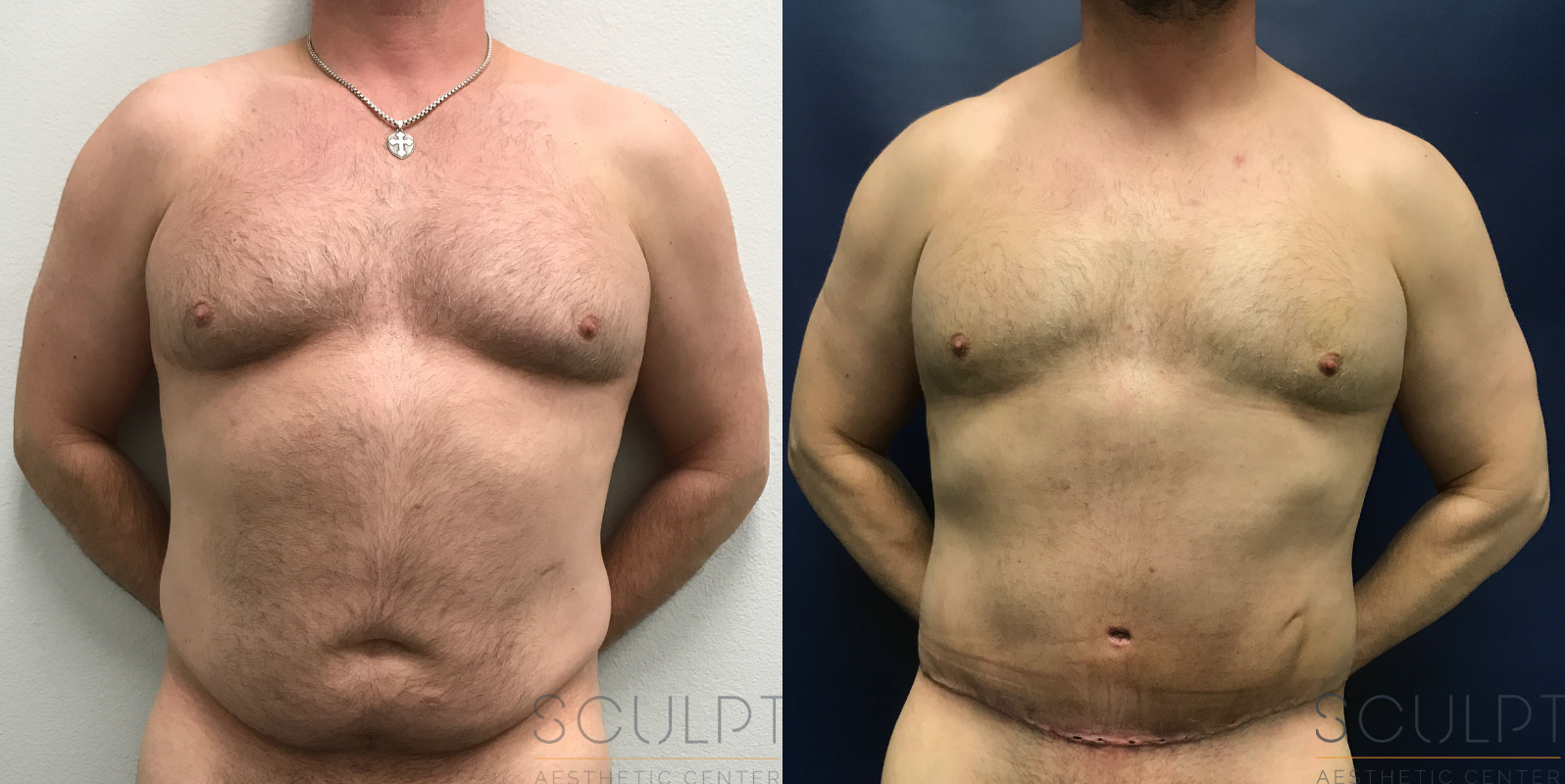 360 Body Lift with Gynecomastia Excision Before and After Photo by Sculpt Aesthetic Center in Frisco, TX