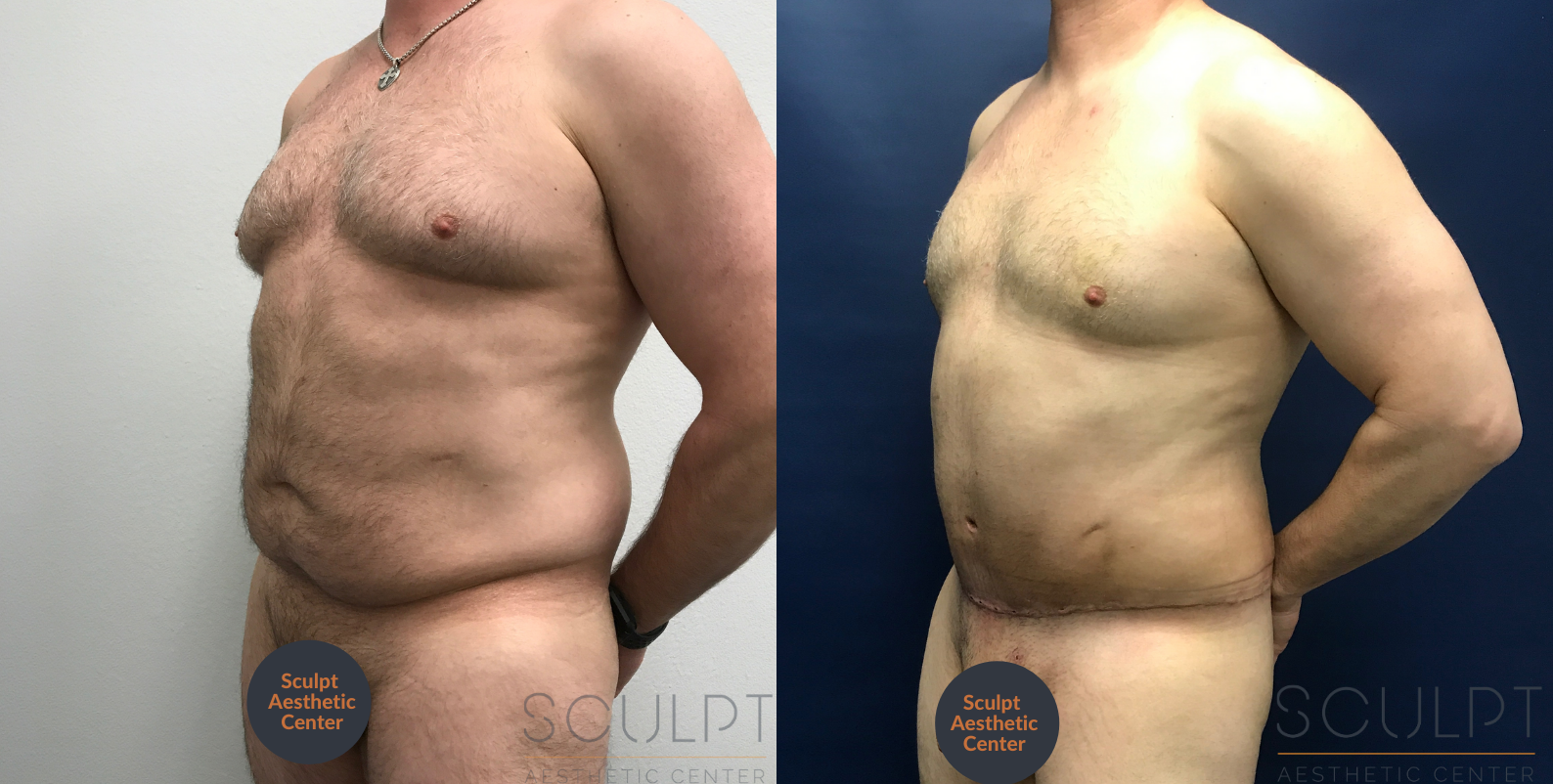 360 Body Lift with Gynecomastia Excision Before and After Photo by Sculpt Aesthetic Center in Frisco, TX