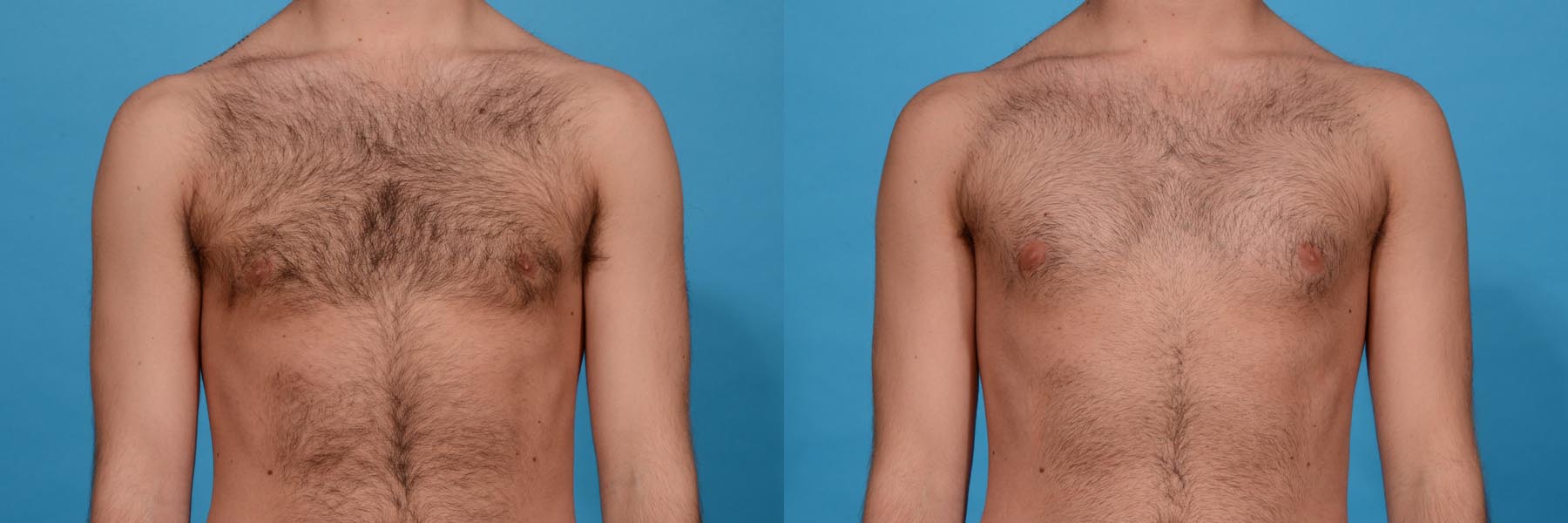 Chest Contouring with Pectoral Augmentation Before and After Photo by Sculpt Aesthetic Center in Frisco, TX
