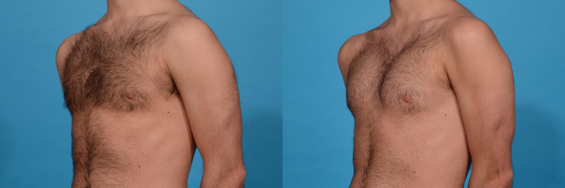 Chest Contouring with Pectoral Augmentation Before and After Photo by Sculpt Aesthetic Center in Frisco, TX