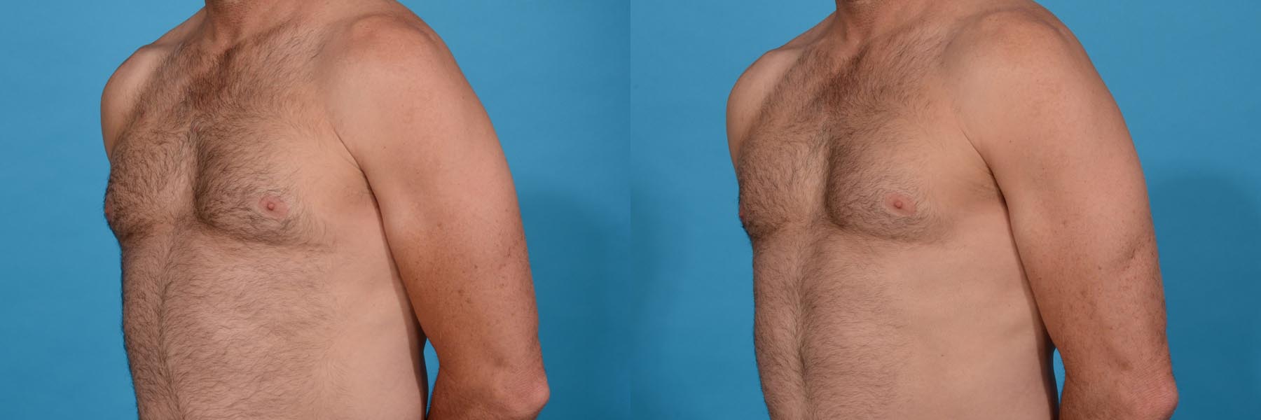 Chest Contouring with Abdominal Etching Before and After Photo by Sculpt Aesthetic Center in Frisco, TX