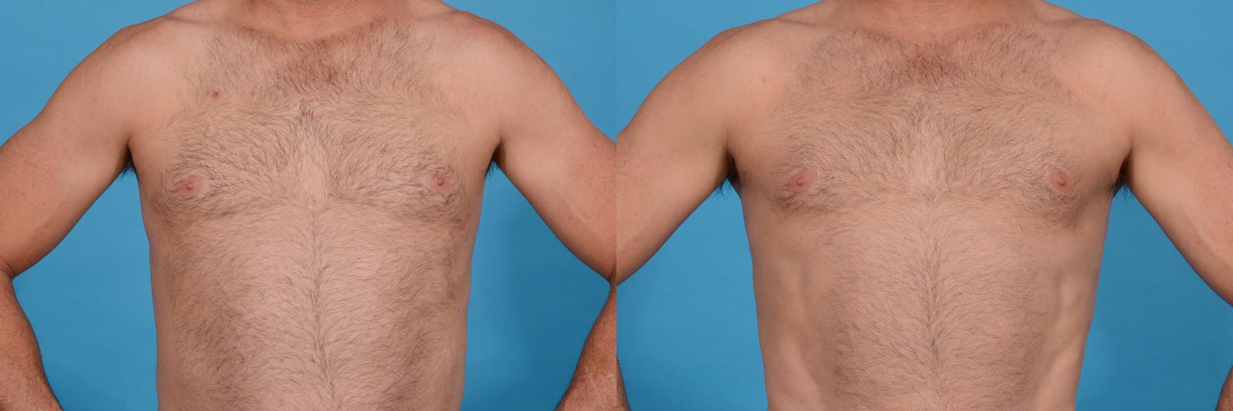 Chest Contouring with Abdominal Etching Before and After Photo by Sculpt Aesthetic Center in Frisco, TX