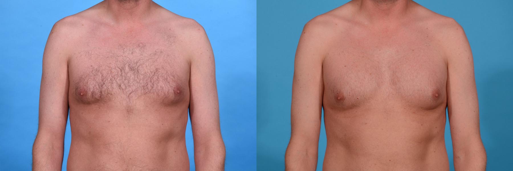 Pectoral Augmentation Before and After Photo by Sculpt Aesthetic Center in Frisco, TX