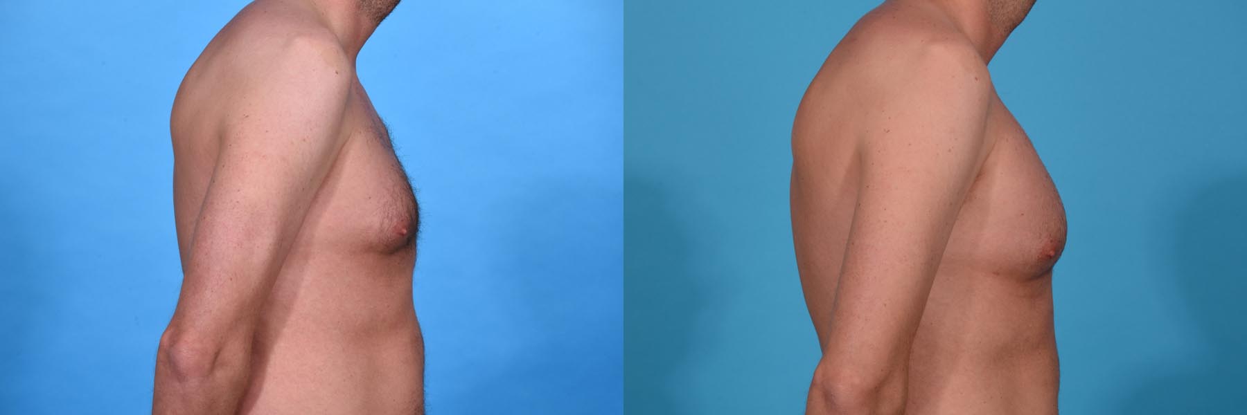 Pectoral Augmentation Before and After Photo by Sculpt Aesthetic Center in Frisco, TX