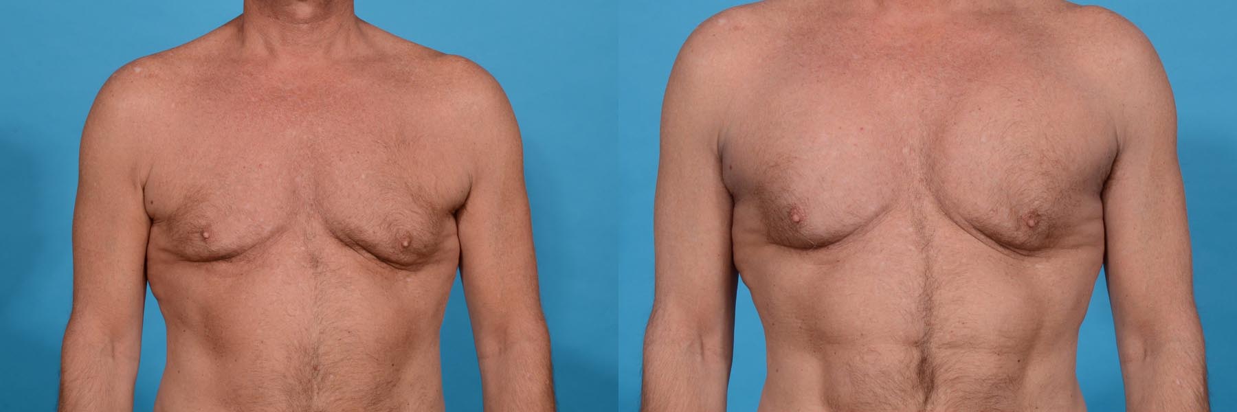 Central Physique Etching with Pectoral Augmentation Before and After Photo by Sculpt Aesthetic Center in Frisco, TX
