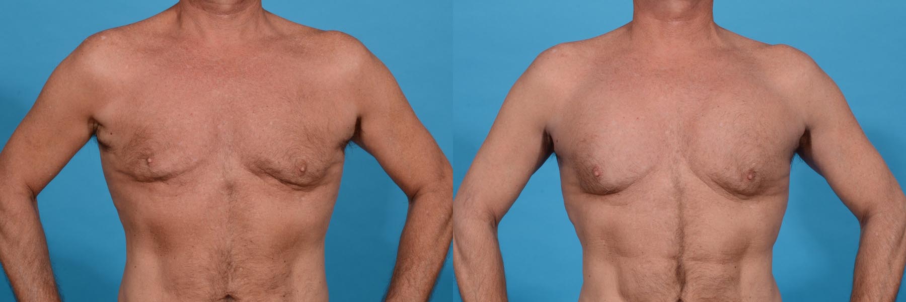 Central Physique Etching with Pectoral Augmentation Before and After Photo by Sculpt Aesthetic Center in Frisco, TX