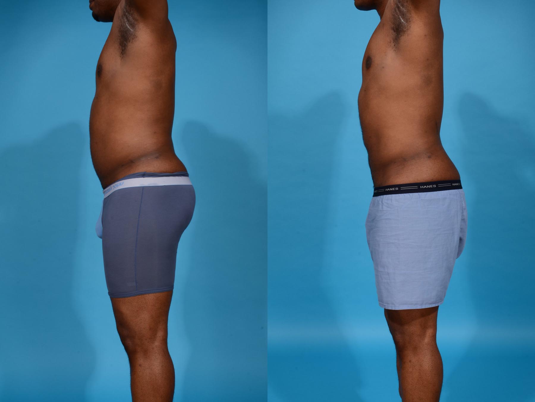 Abdominal Etching Before and After Photo by Sculpt Aesthetic Center in Frisco, TX