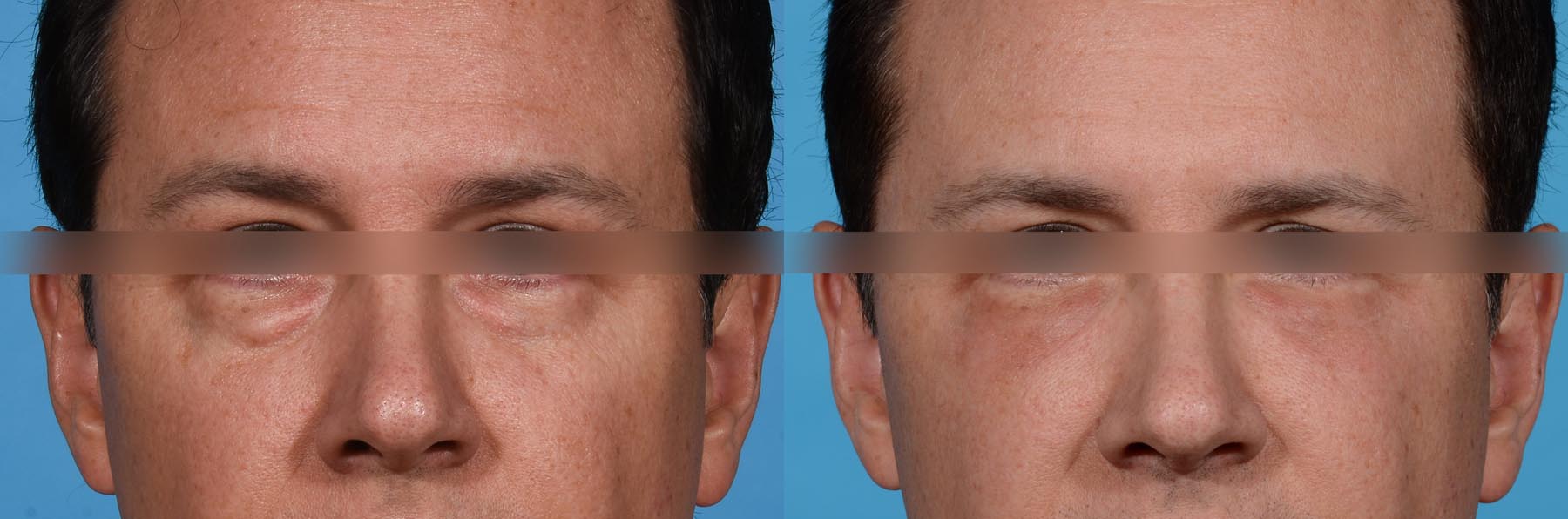Eyelid Lift Before and After Photo by Sculpt Aesthetic Center in Frisco, TX