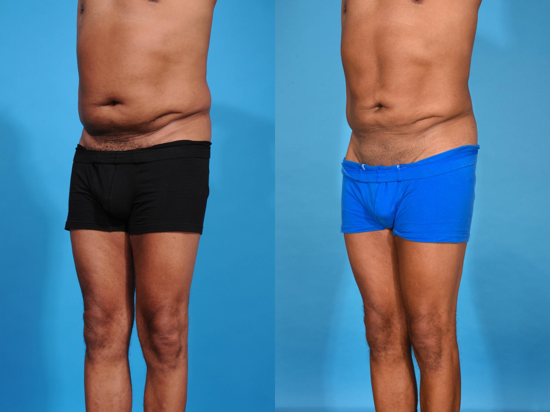 Tummy Tuck Before and After Photo by Sculpt Aesthetic Center in Frisco, TX