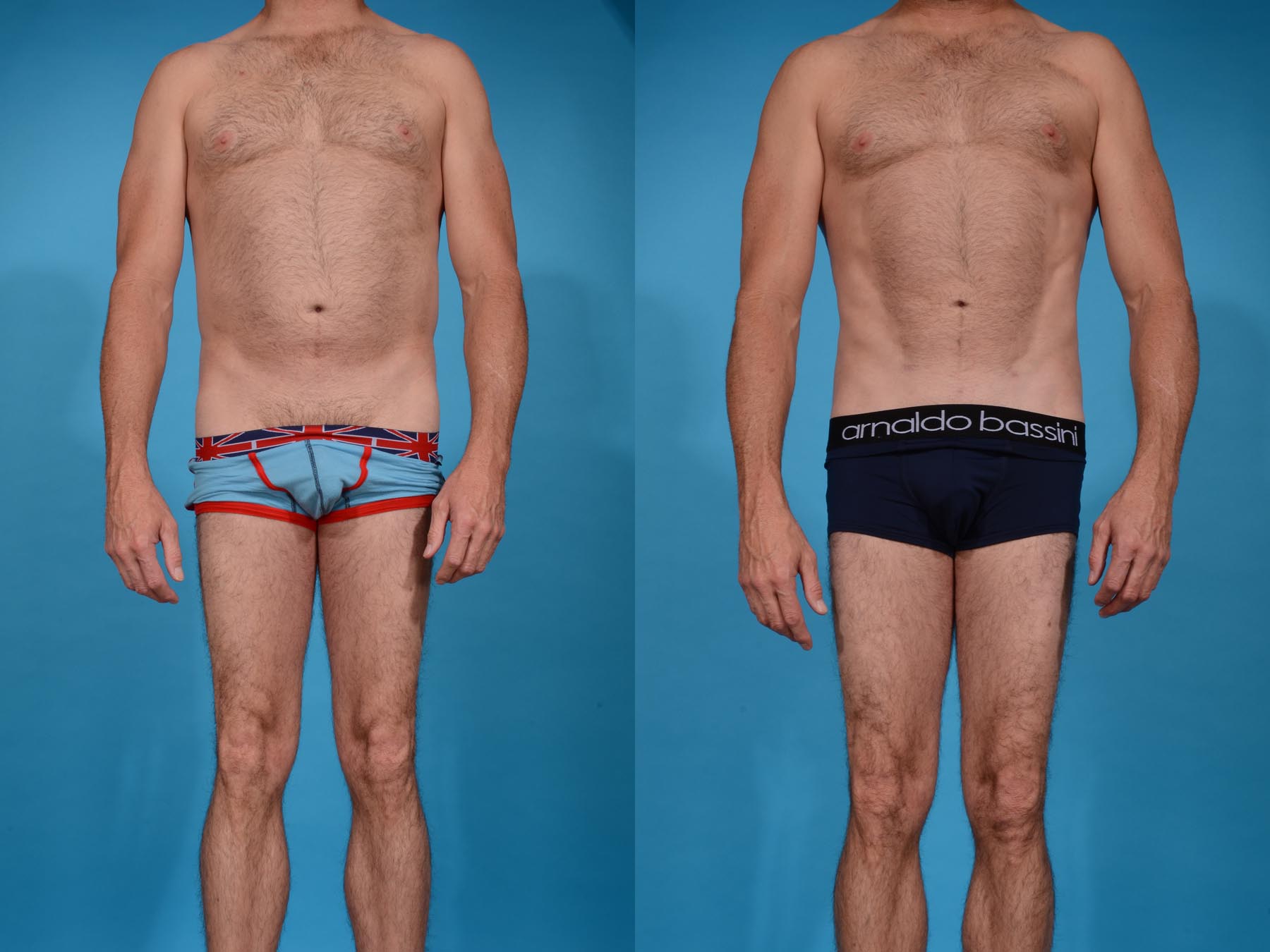 ABDOMINAL ETCHING WITH VASER HI-DEFINITION LIPOSCULPTING Before and After Photo by Sculpt Aesthetic Center in Frisco, TX