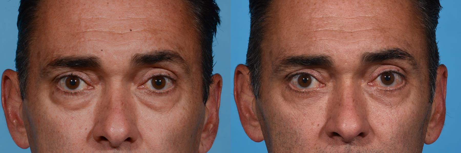 Lower Eyelid Lift Before and After Photo by Sculpt Aesthetic Center in Frisco, TX