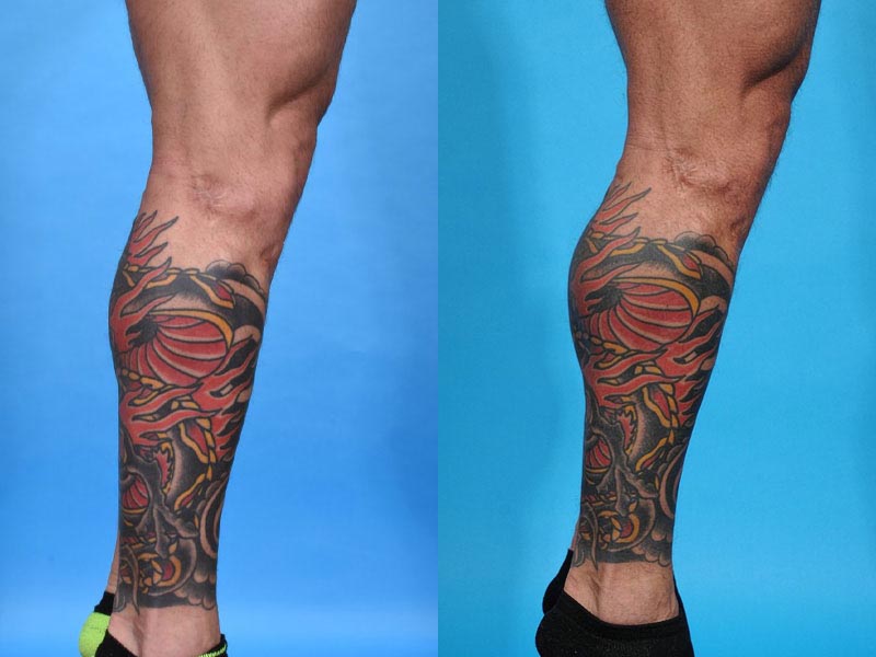 Calf Augmentation with Calf Implants Before and After Photo by Sculpt Aesthetic Center in Frisco, TX