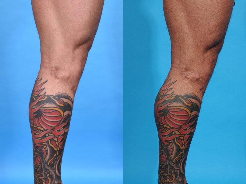 Calf Augmentation with Calf Implants Before and After Photo by Sculpt Aesthetic Center in Frisco, TX