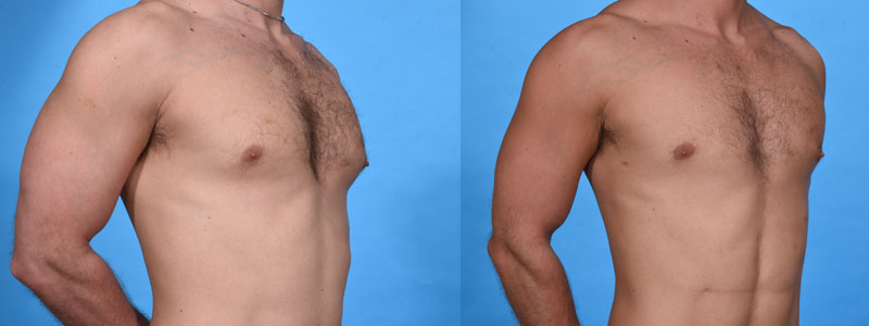 Gynecomastia Plus VASER Liposculpting and Lipocontouring Before and After Photo by Sculpt Aesthetic Center in Frisco, TX
