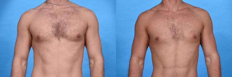 Gynecomastia Plus VASER Liposculpting and Lipocontouring Before and After Photo by Sculpt Aesthetic Center in Frisco, TX