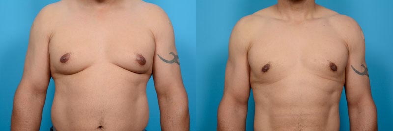 Gynecomastia Excision Plus Hi-Definition VASER Liposculpture Before and After Photo by Sculpt Aesthetic Center in Frisco, TX