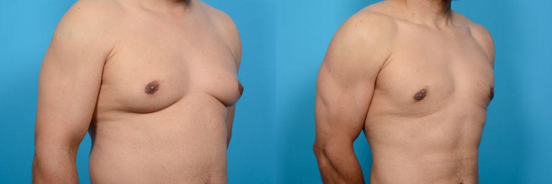 Gynecomastia Excision Plus Hi-Definition VASER Liposculpture Before and After Photo by Sculpt Aesthetic Center in Frisco, TX