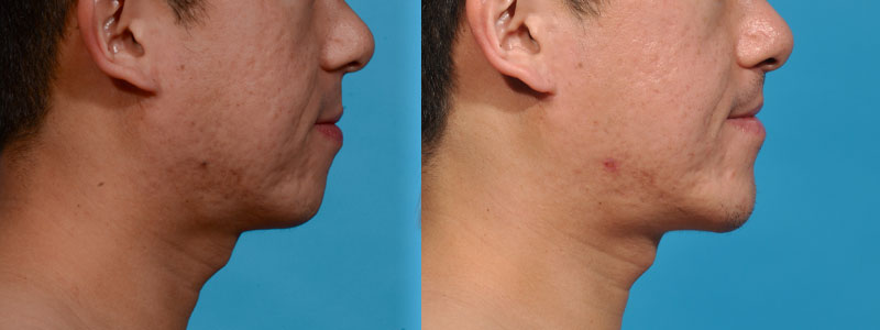 Chin Augmentation Before and After Photo by Sculpt Aesthetic Center in Frisco, TX