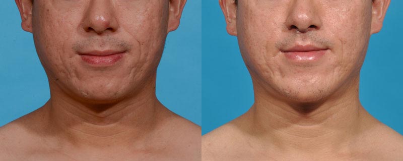 Chin Augmentation Before and After Photo by Sculpt Aesthetic Center in Frisco, TX