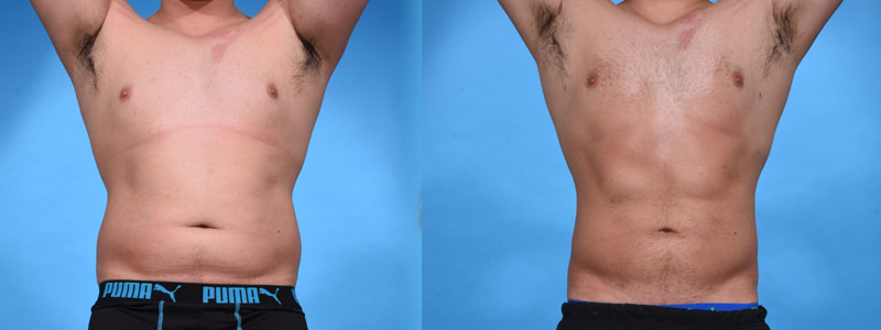 High definition VASER Assisted Liposculpture Before and After Photo by Sculpt Aesthetic Center in Frisco, TX