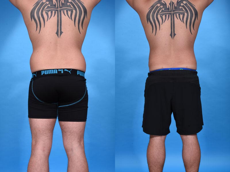 High definition VASER Assisted Liposculpture Before and After Photo by Sculpt Aesthetic Center in Frisco, TX