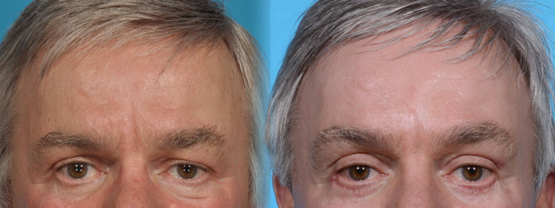 Forehead and Brow Lift Plus Eyelid Lift Before and After Photo by Sculpt Aesthetic Center in Frisco, TX