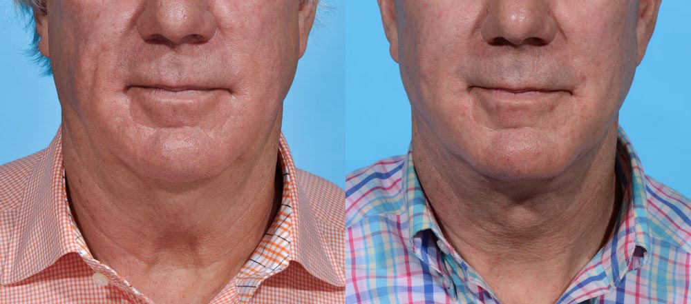 Neck Lift Before and After Photo by Sculpt Aesthetic Center in Frisco, TX