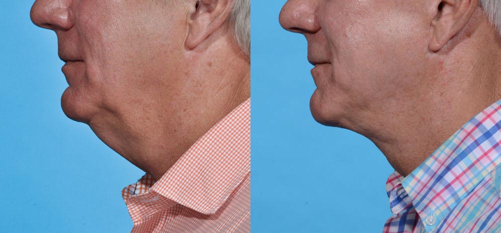 Neck Lift Before and After Photo by Sculpt Aesthetic Center in Frisco, TX