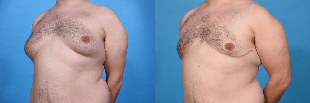 Gynecomastia Excision, VASER Liposculpting Before and After Photo by Sculpt Aesthetic Center in Frisco, TX