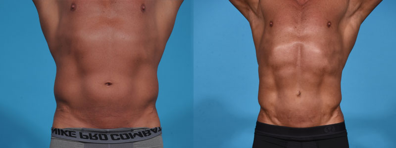 Abdominal Etching with high definition Liposculpting Before and After Photo by Sculpt Aesthetic Center in Frisco, TX