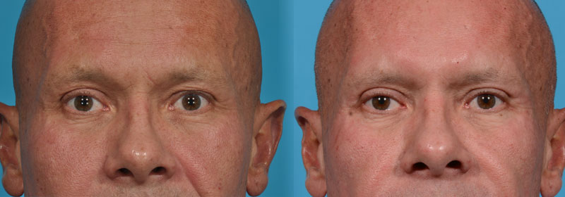 Upper Eyelid Lift Before and After Photo by Sculpt Aesthetic Center in Frisco, TX