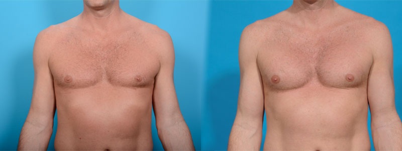 Pectoral Implants Before and After Photo by Sculpt Aesthetic Center in Frisco, TX