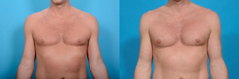 Pectoral Implants Before and After Photo by Sculpt Aesthetic Center in Frisco, TX