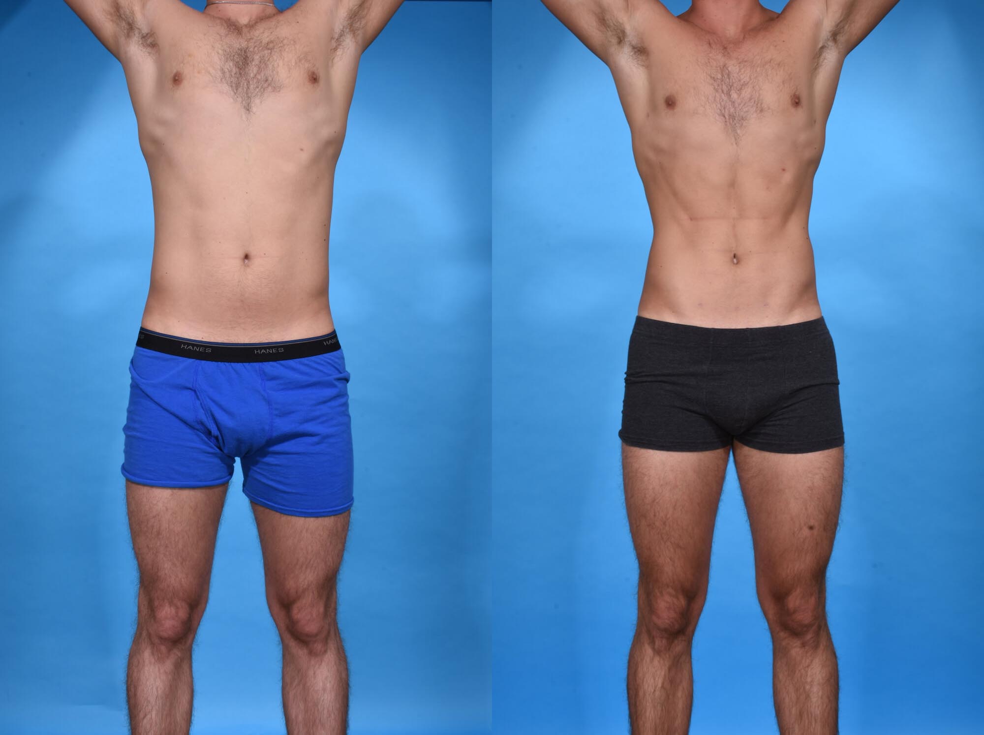 Abdominal Etching Before and After Photo by Sculpt Aesthetic Center in Frisco, TX