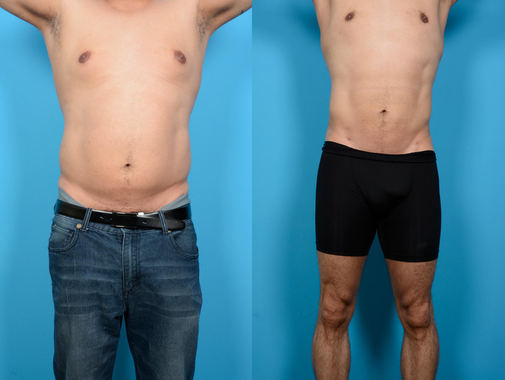 Abdominal Etching Plus Vaser Before and After Photo by Sculpt Aesthetic Center in Frisco, TX