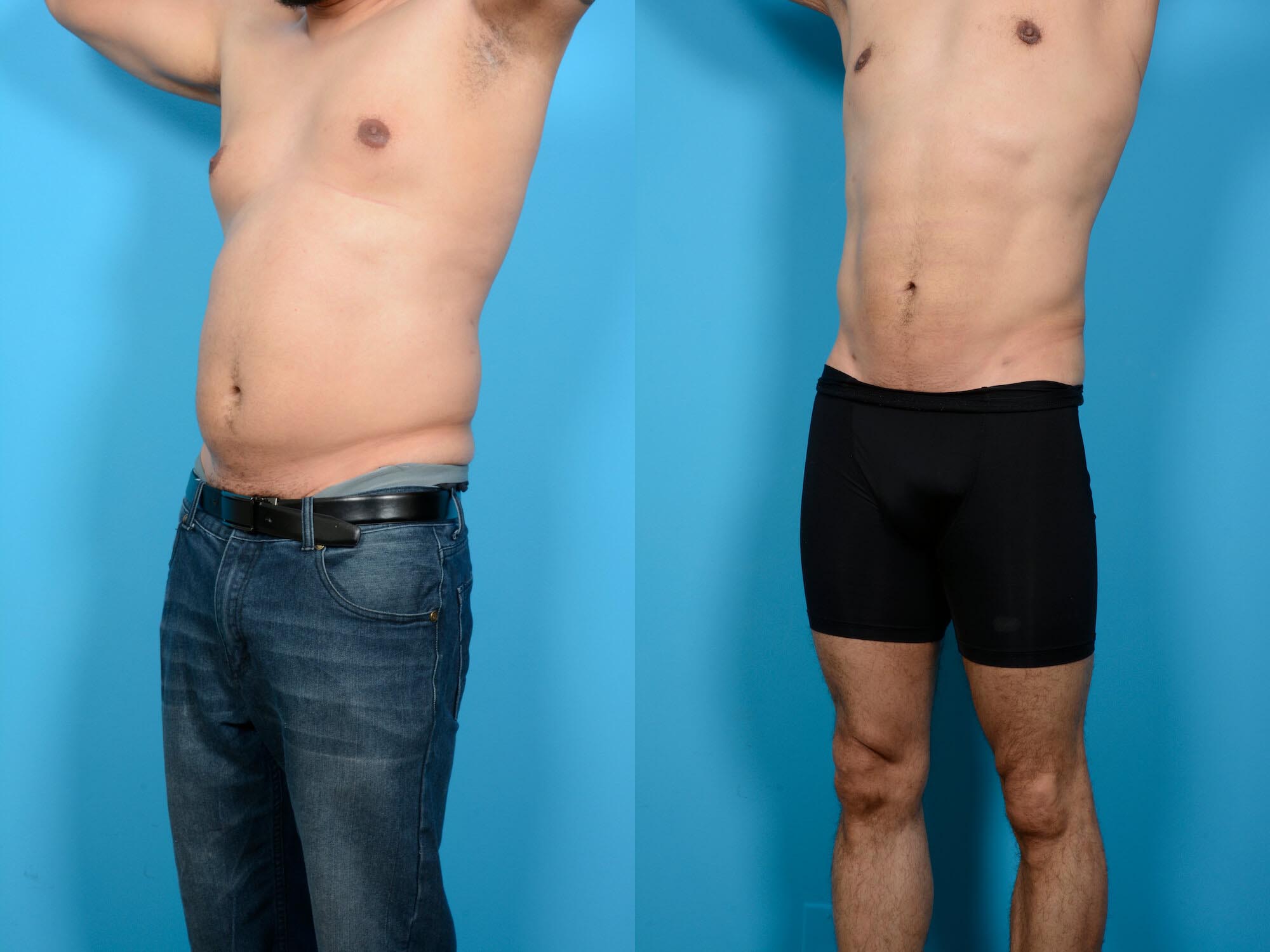 Abdominal Etching Plus Vaser Before and After Photo by Sculpt Aesthetic Center in Frisco, TX